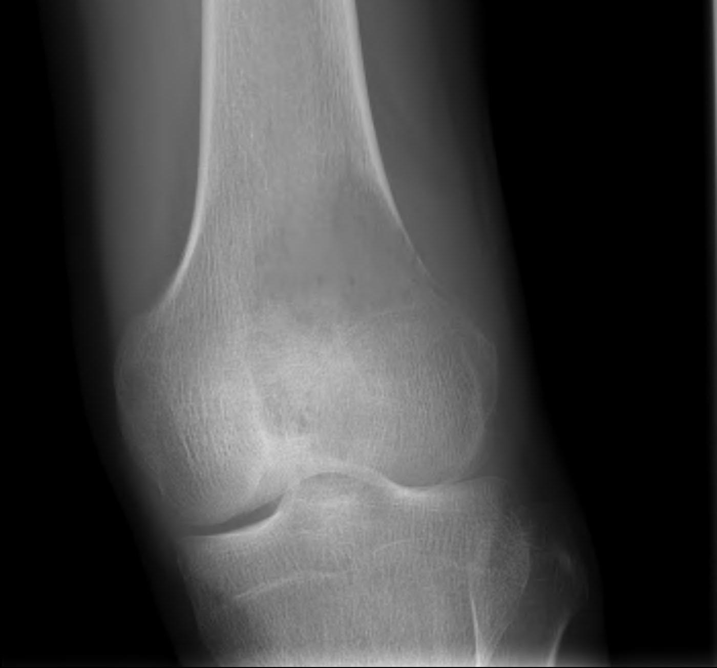 Bony Lesion Lateral Distal Femur